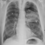 x ray of lung cancer